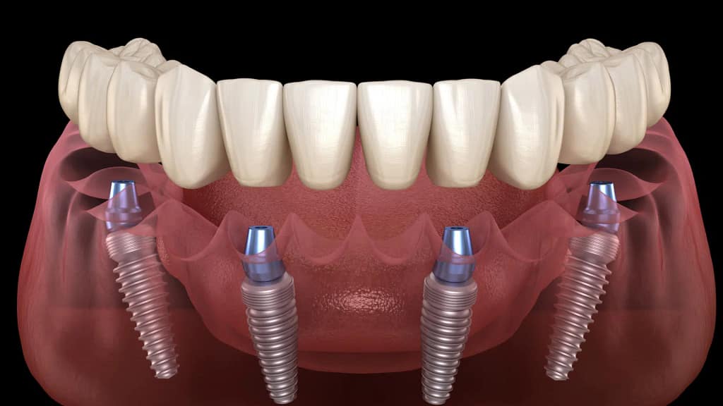 Dantų implantavimas All-on-4