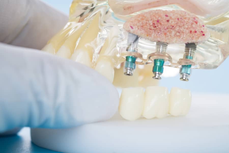Dantų implantai-Senvagės klinika-Odontologijos klinika Panevėžyje